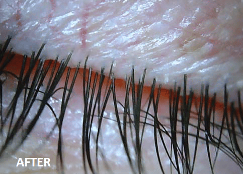 Eyelashes After Use BlephEx